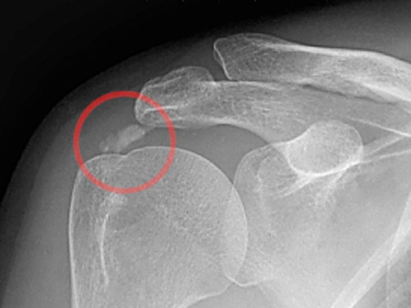 Artroszkópos kalcium depozit kiürítés