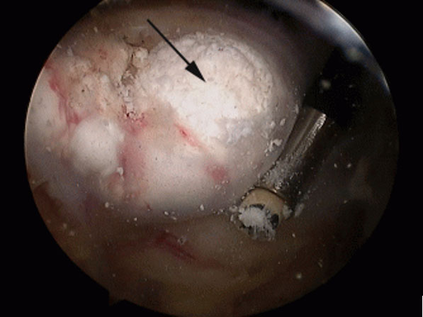 Artroszkópos kalcium depozit kiürítés