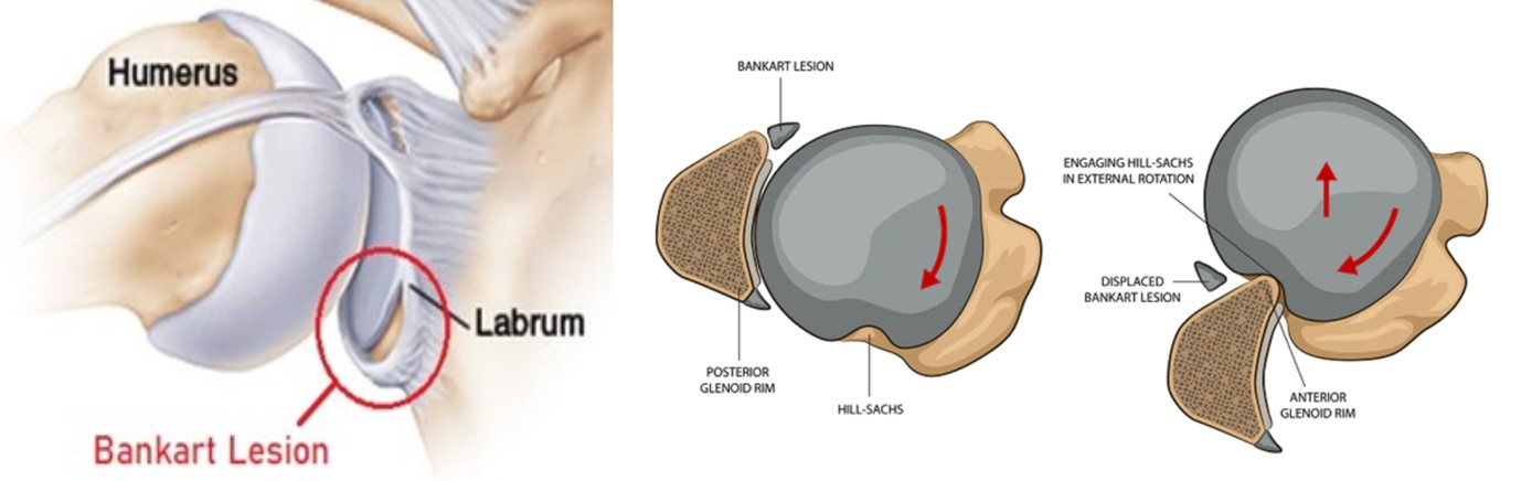 Labrum sérülés és vállízületi instabilitás műtéti ellátása