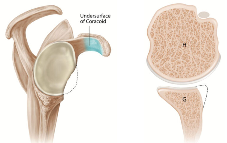 Labrum sérülés és vállízületi instabilitás műtéti ellátása