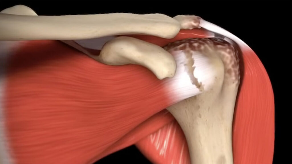 Rotátorköpeny hiány